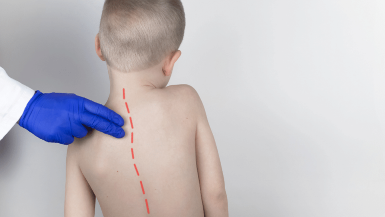 Paciente infantil con escoliosis juvenil. Centro de la Columna Vertebral.
